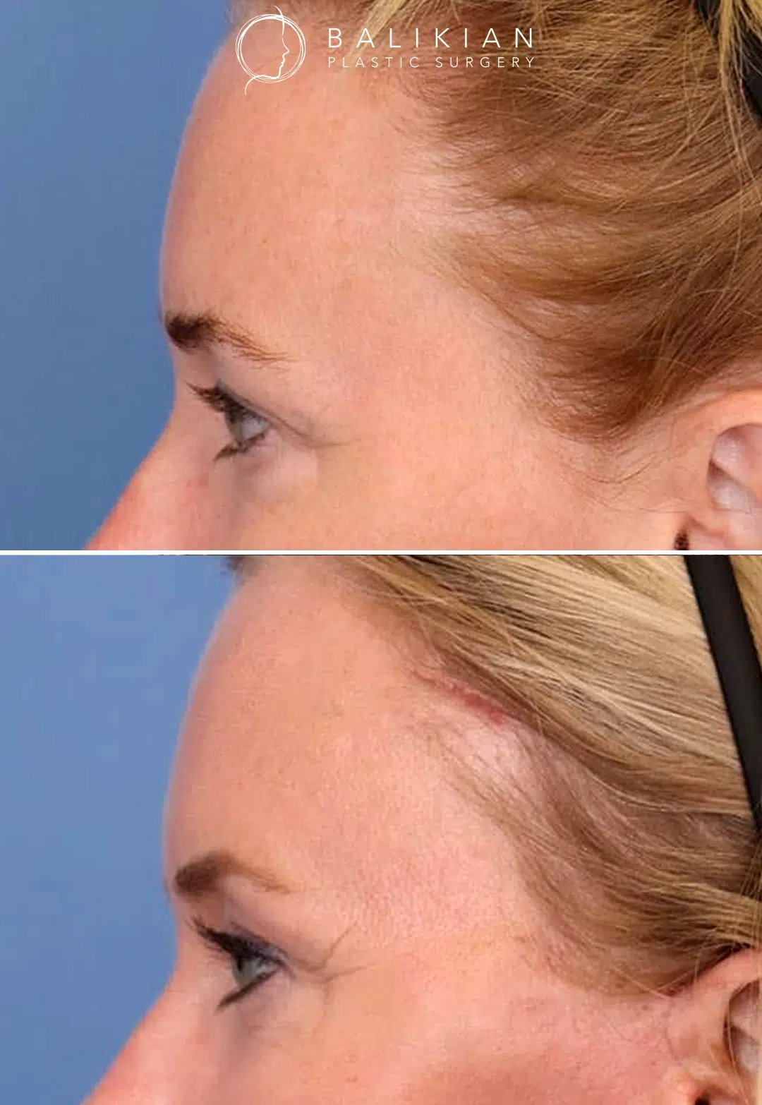 A temporal brow lift was performed to gently elevate the outer brow and enhance the openness of the eyes. At six weeks, the brow position is already more youthful, with swelling continuing to settle over the year. Side view before and after photo showing a higher brow position and smoother temple area following a temporal brow lift.