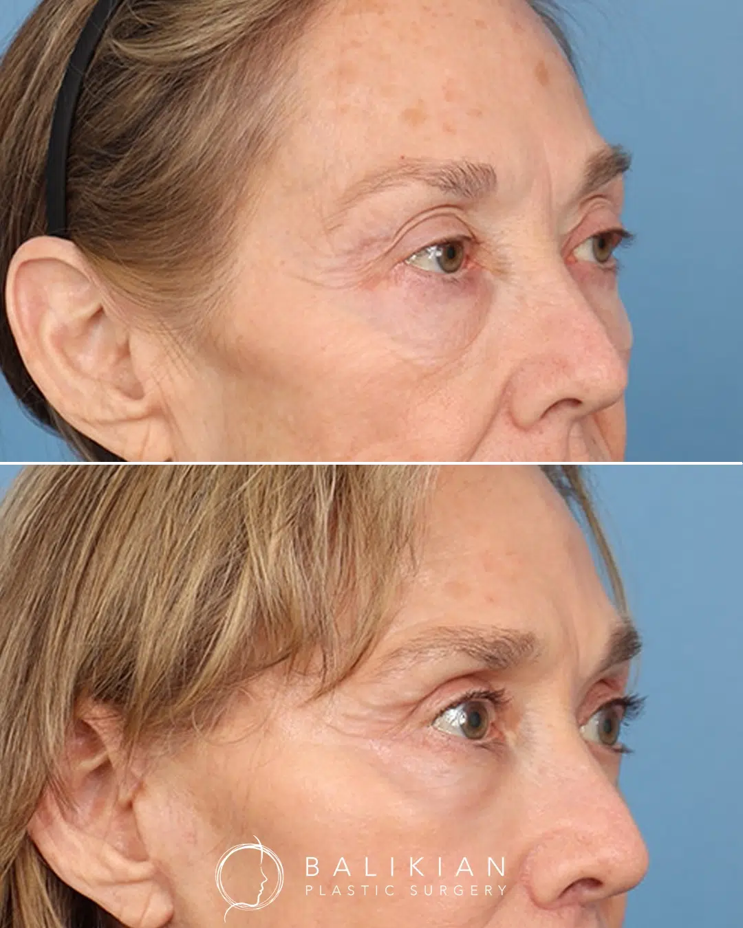 The after photo shows smoother eyelid contours and a softer transition from the eyelid to the cheek, reducing tired shadows. Before and after upper and lower blepharoplasty, angled view. Under-eye bulging is reduced, eyelid creases appear smoother, and the eyes look more lifted and defined post-surgery.