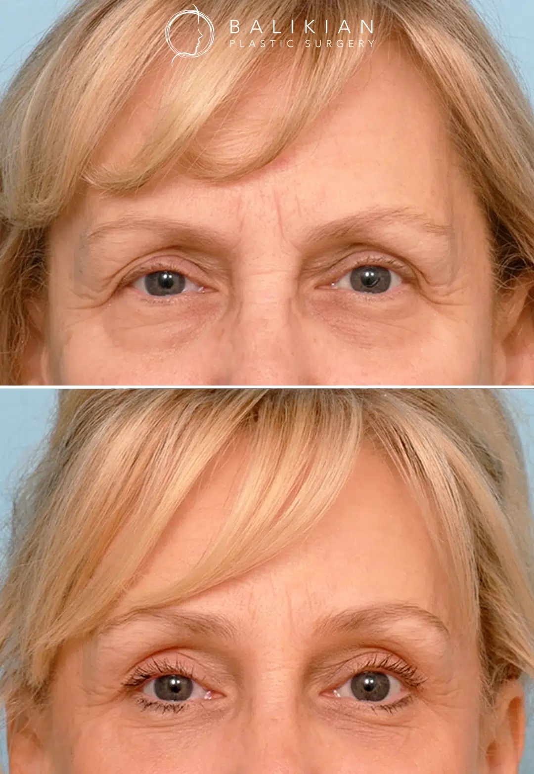 A four point brow lift was used to address heavy brows and improve symmetry. This created a lighter, more open upper eyelid appearance when combined with her eyelid procedures. Temporal brow lift before and after image showing softened forehead lines and a more youthful brow arch.