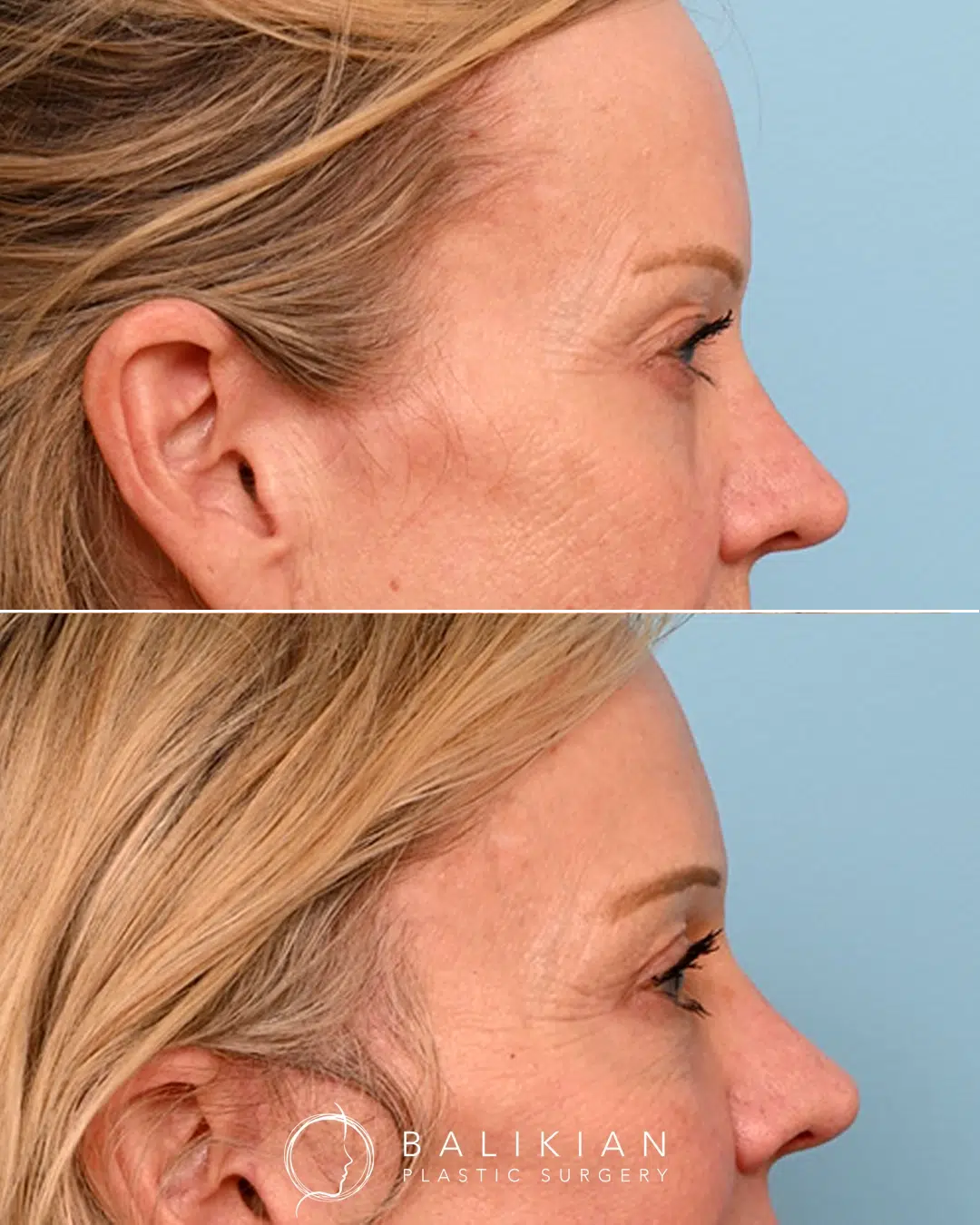 The after view shows smoother skin, less creasing, and more definition around the eyes. Angled before and after of upper and lower eyelid surgery. After images reveal tightened upper lids, softened crow’s feet, and improved lower-lid contour.