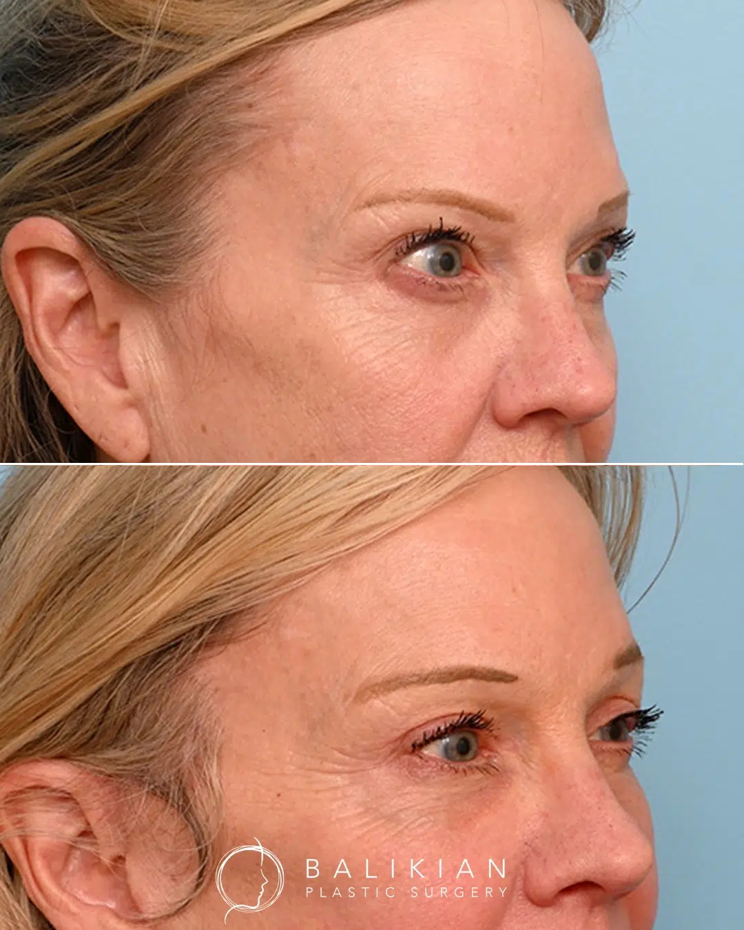 Side profile shows a cleaner lid crease and reduced under-eye fullness. Side-view before and after blepharoplasty. Post-surgery, the upper lids appear lighter, and the lower lids show reduced puffiness and smoother texture.