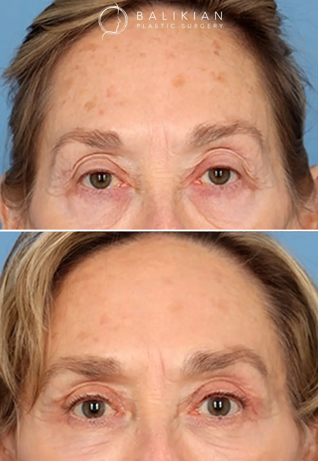 Dr. Balikian performed a temporal brow lift as part of this patient’s comprehensive facial rejuvenation, helping elevate the outer brow and open the upper eye area for a naturally refreshed look. Before and after frontal photo of a woman in her seventies showing significant improvement in brow position and upper facial rejuvenation.