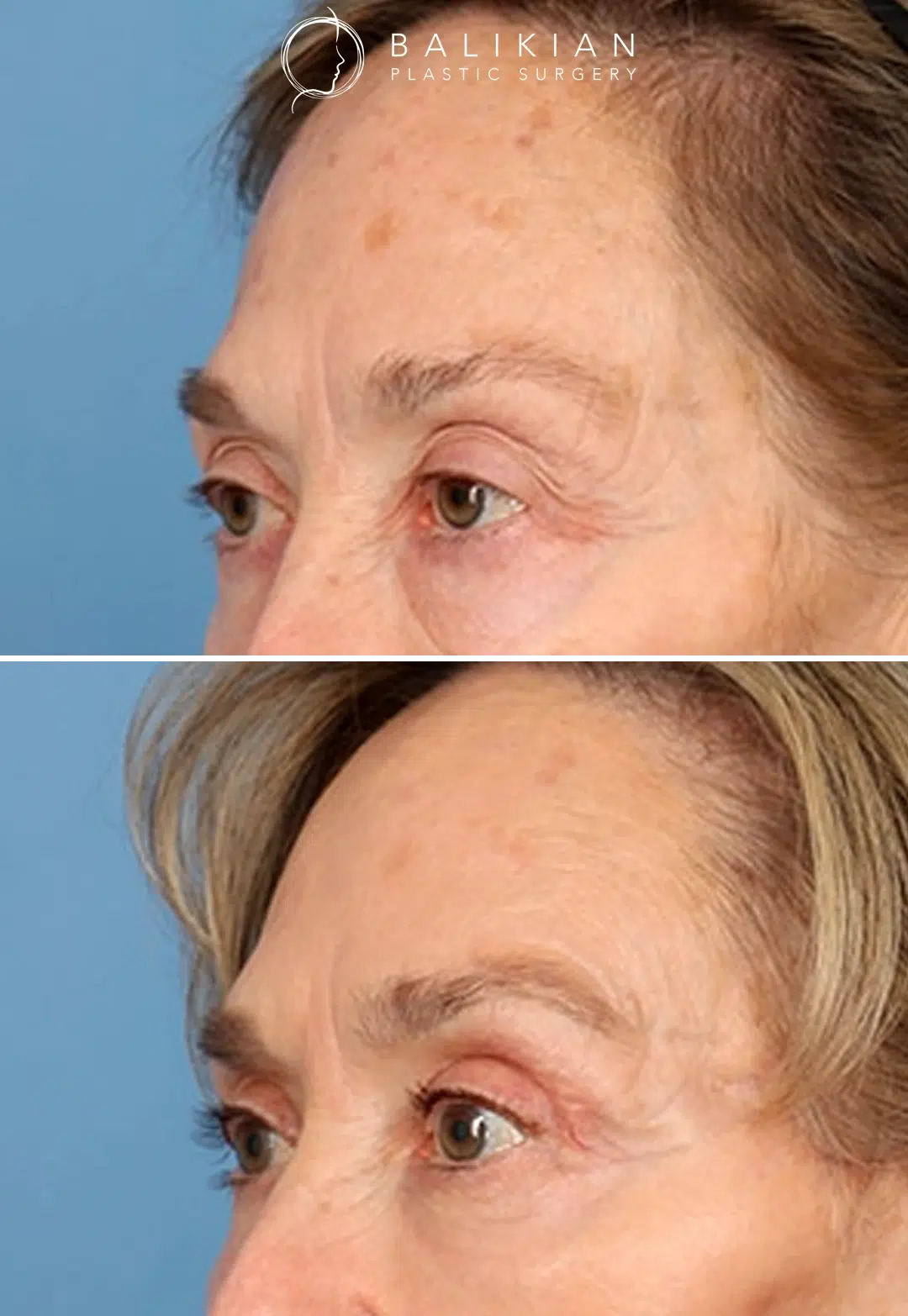 Dr. Balikian performed a temporal brow lift as part of this patient’s comprehensive facial rejuvenation, helping elevate the outer brow and open the upper eye area for a naturally refreshed look. Oblique view before and after comparison of a woman in her seventies with elevated brows and smoother upper eyelids after brow lift surgery.