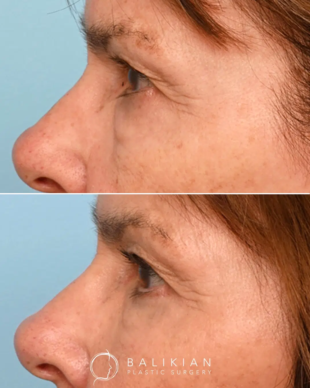 The before image shows visible under-eye bags and looseness in the lower lid. After surgery, the under-eye area appears flatter and smoother, with a more refreshed transition from the eyelid to the cheek. Side view before and after lower blepharoplasty showing improvement in under-eye bags, smoother lower eyelid contour and reduced puffiness performed by Dr. Richard Balikian.