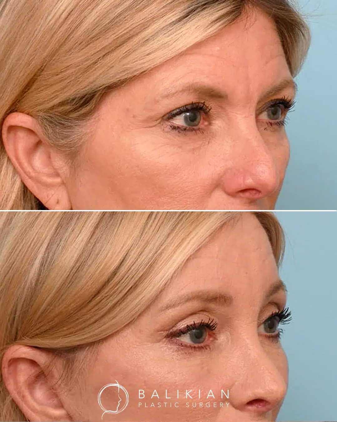 Heavy upper eyelid skin has been lifted, restoring a cleaner crease and a more awake appearance. Upper blepharoplasty before and after photo showing removal of excess upper eyelid skin and improved eyelid definition.