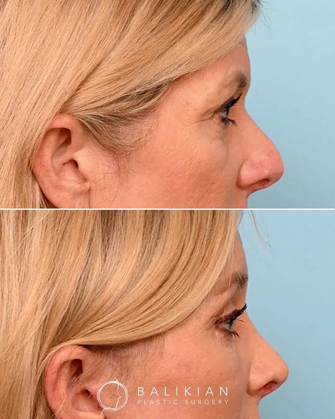 After surgery, the crease is more visible and the excessive skin over the lashes has been removed for a refreshed look. Angled view before and after upper eyelid surgery showing improved eyelid crease visibility and reduced sagging skin.