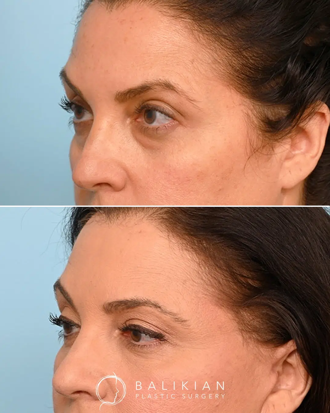 This patient in her early 50s underwent comprehensive facial rejuvenation, including upper and lower eyelid surgery. Dr. Balikian performed a deep plane face and neck lift, eyelid rejuvenation, and facial fat transfer. She is shown three months postoperatively with a smoother, brighter eye area. Angled before and after view of upper and lower eyelid rejuvenation showing smoother contours around the eyes and improved definition of the upper eyelids. Hooding and puffiness are significantly reduced.