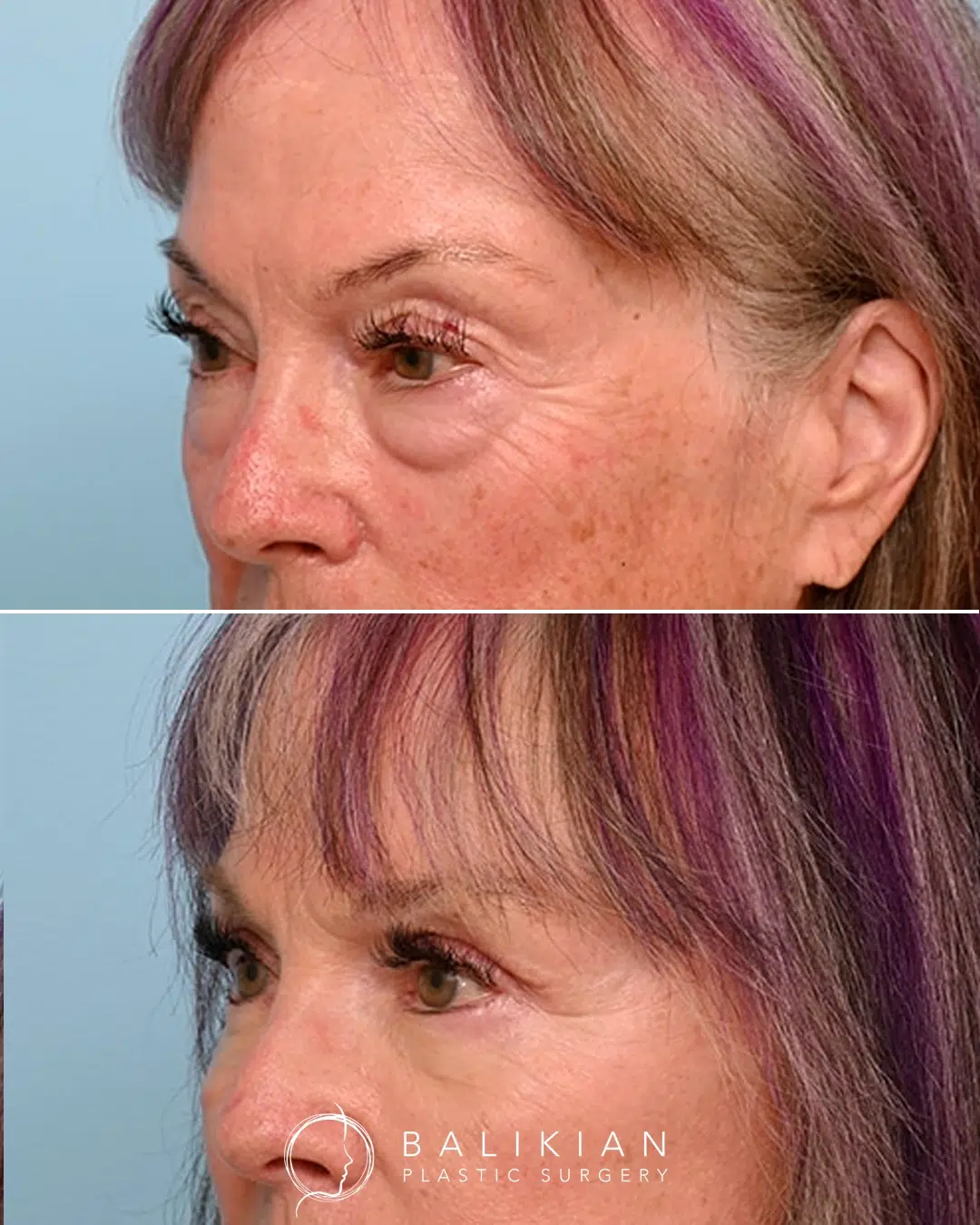 This patient in her 70s wanted improvement in both her upper and lower eyelids. Dr. Balikian performed upper blepharoplasty, scarless lower blepharoplasty, and fat transfer to brighten and rejuvenate her eyes. Angled before and after comparison following upper and lower blepharoplasty showing improved eyelid contour. The upper lids are no longer hooded and the lower lid bags are reduced.