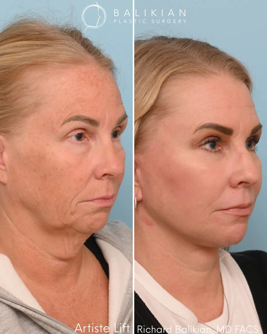 Deep plane facelift before and after demonstrating tighter jawline, reduced jowling, and improved cheek support with natural, refreshed definition.