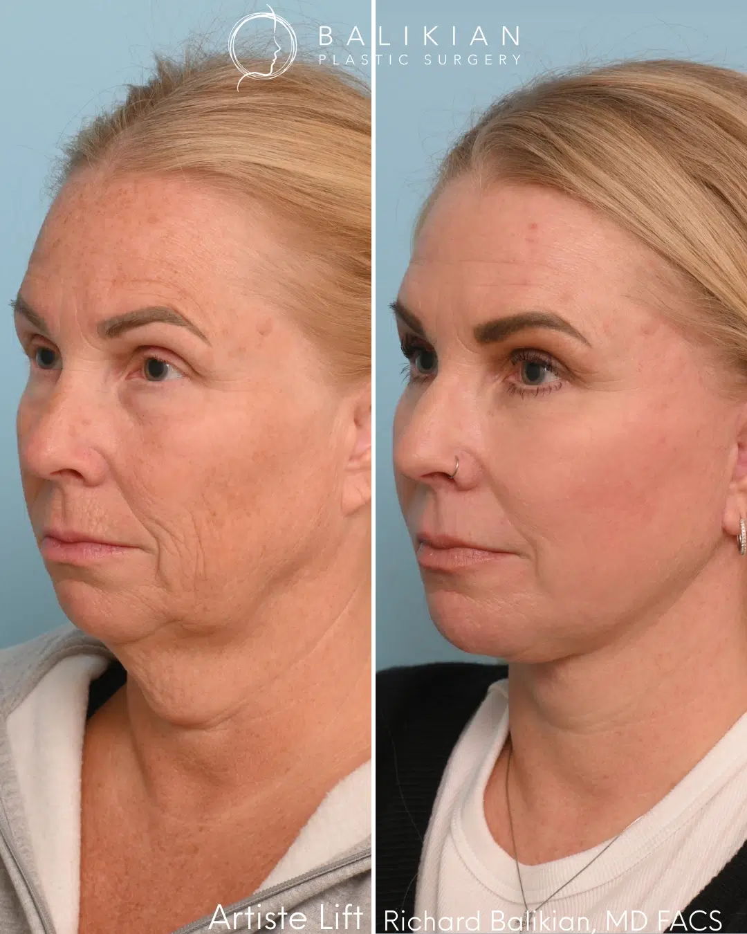 Before and after deep plane facelift showing smoother neck contour, lifted jawline, and refined lower face fullness after Dr. Balikian’s Artiste Lift.