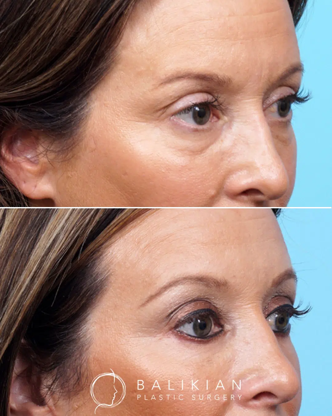 Before and after lower blepharoplasty demonstrating removal of under eye puffiness while maintaining the patient’s natural eye shape and expression.