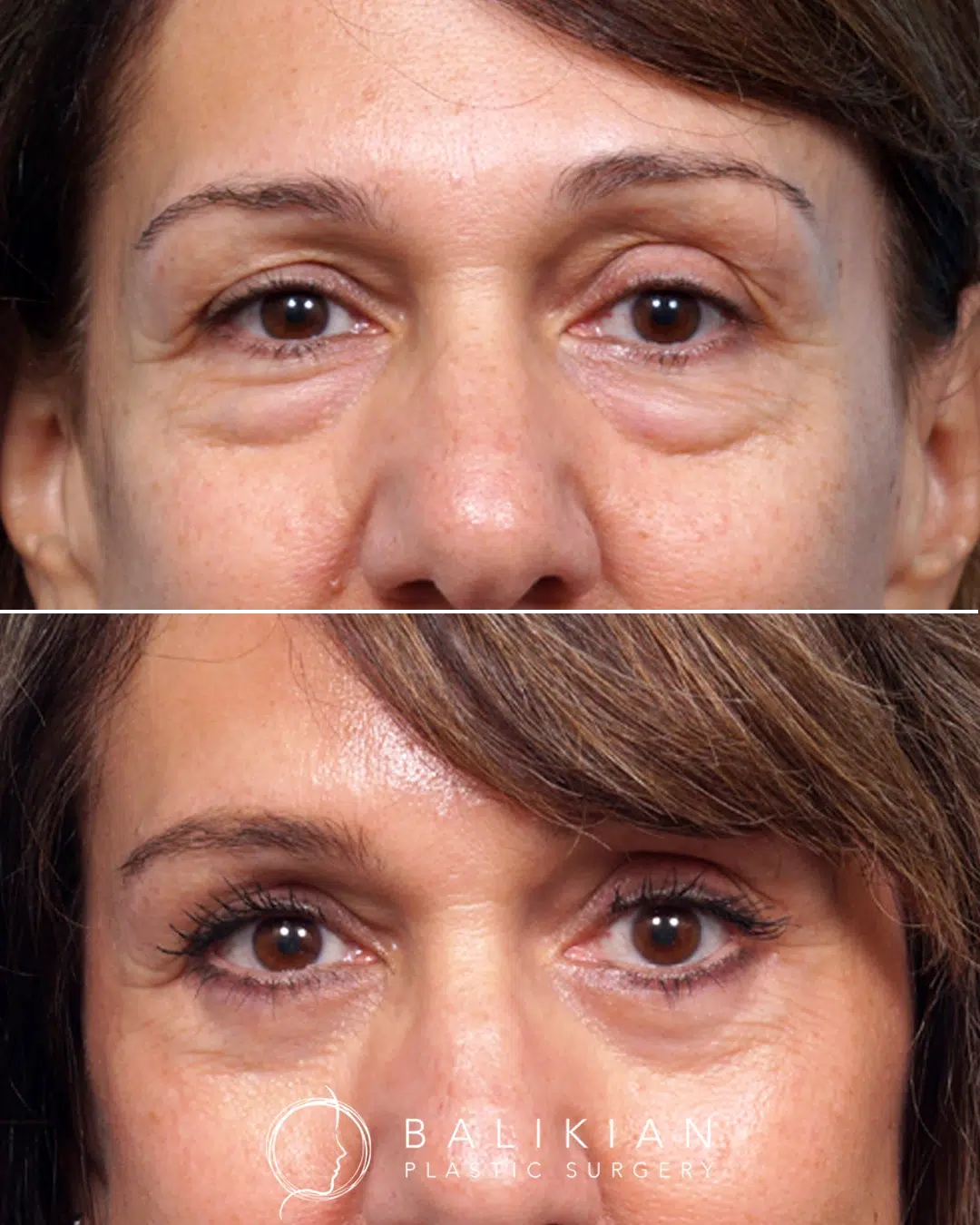 Before and after lower blepharoplasty highlighting the correction of prominent under eye bags and a brighter, less tired eyelid appearance.