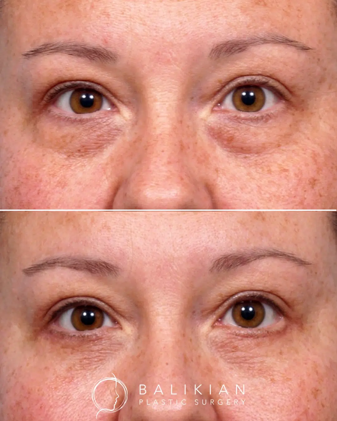 Before and after lower blepharoplasty showing smoother lower eyelids, reduced sagging, and improved contour beneath the eyes.