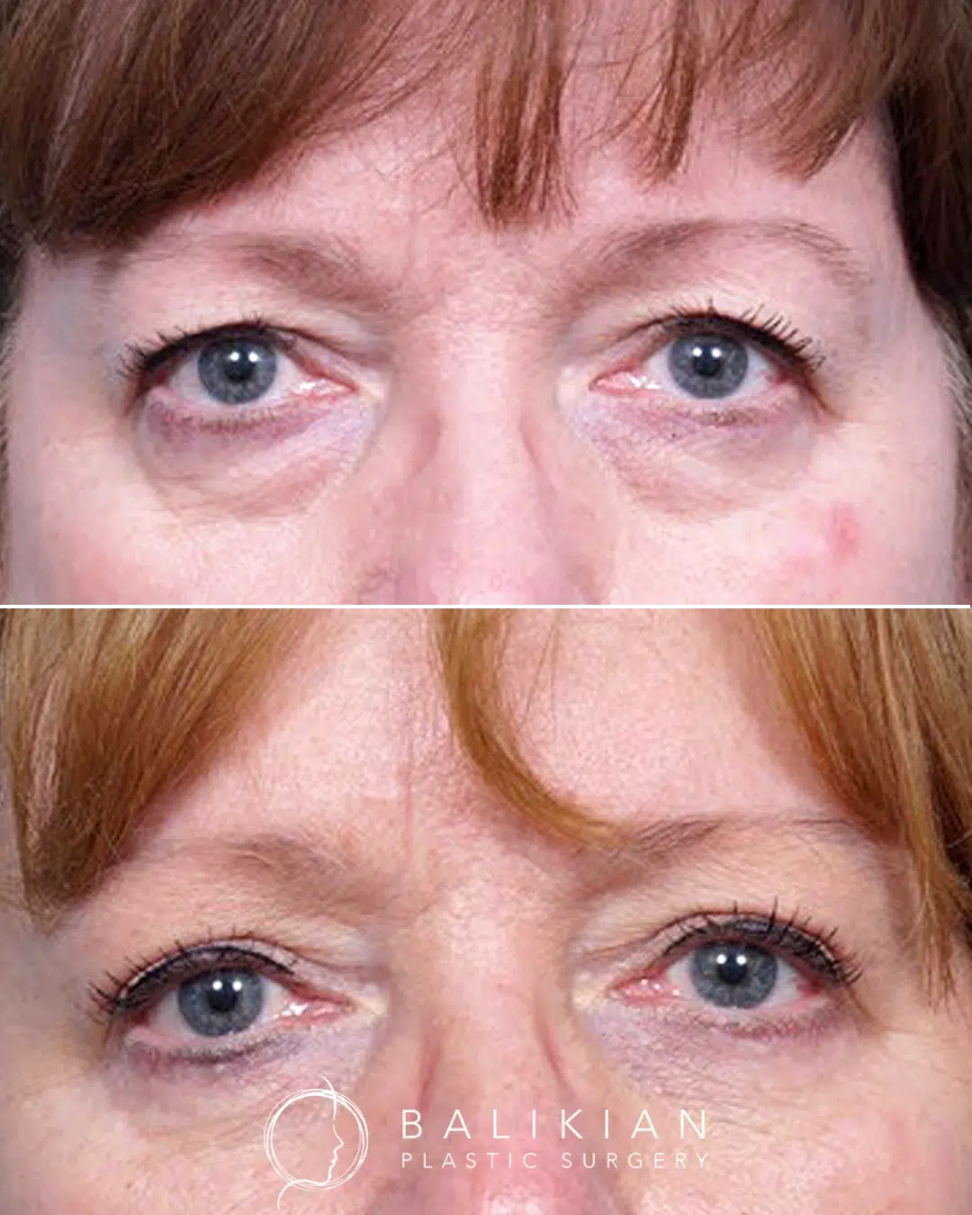 Before and after lower blepharoplasty showing reduced under eye bags and smoother lower eyelids, creating a more refreshed and rested appearance.