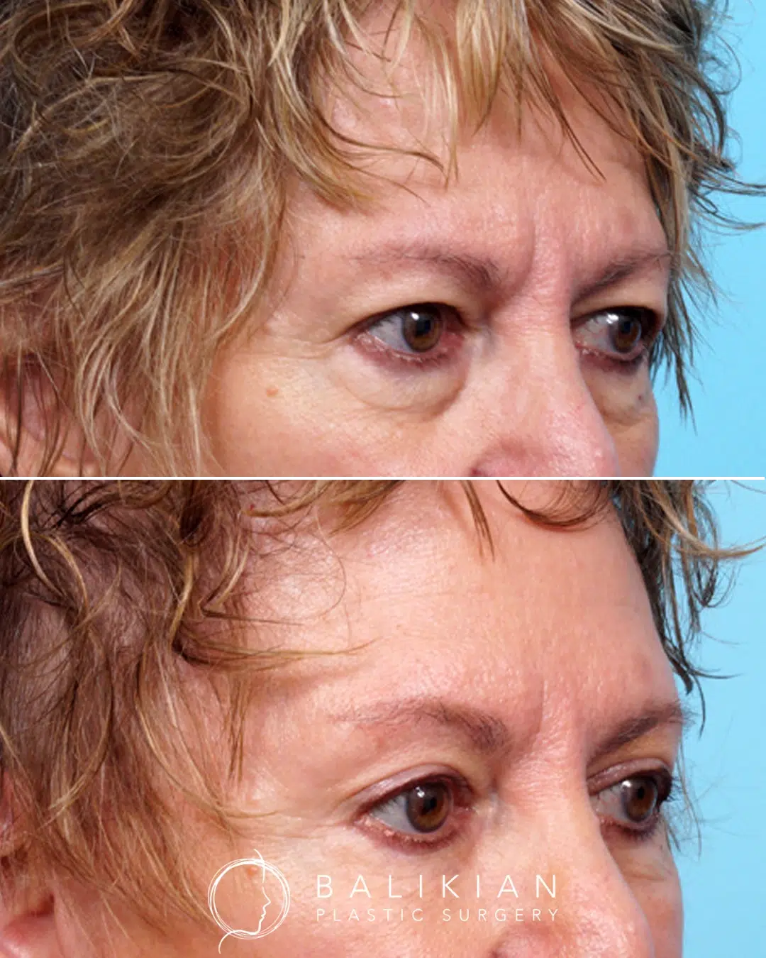 Before and after quad blepharoplasty in an oblique view showing lifted upper lids, reduced lower eyelid fullness, and an overall refreshed eye appearance.