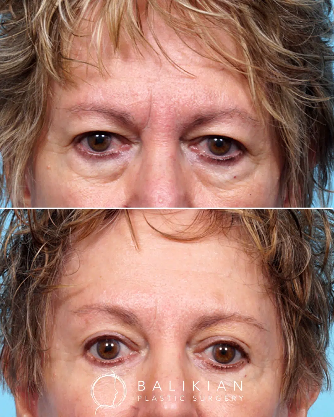 Before and after quad blepharoplasty showing lifted upper eyelids and reduced fullness under the eyes, giving the patient a more open, refreshed appearance.