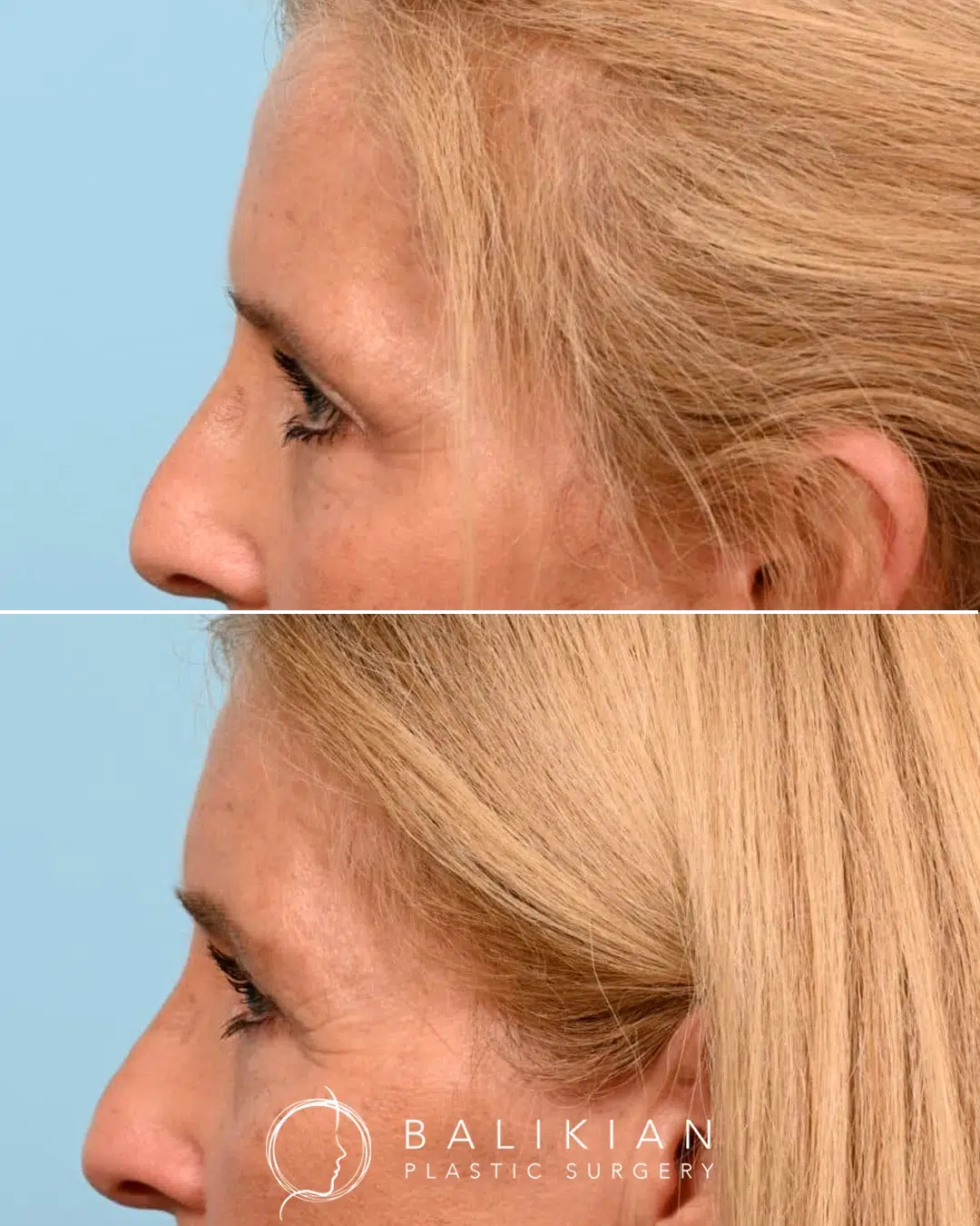 Before and after upper blepharoplasty in profile view showing smoother upper eyelids, reduced heaviness, and a more open eye contour.