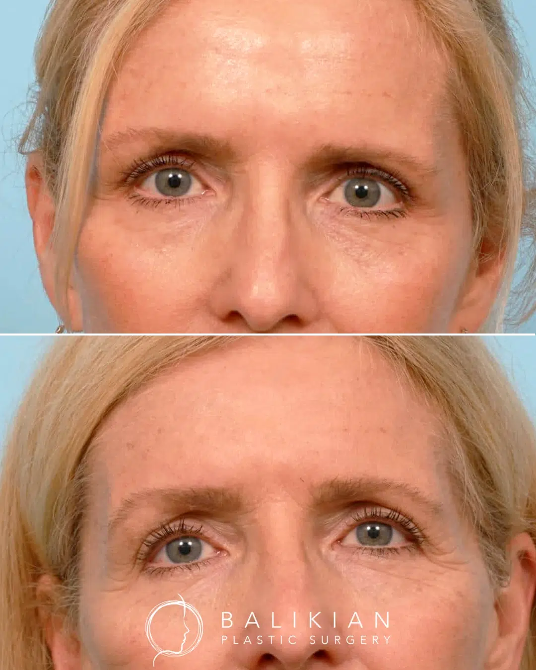 Before and after upper blepharoplasty showing lifted upper eyelids and a brighter, less tired appearance.