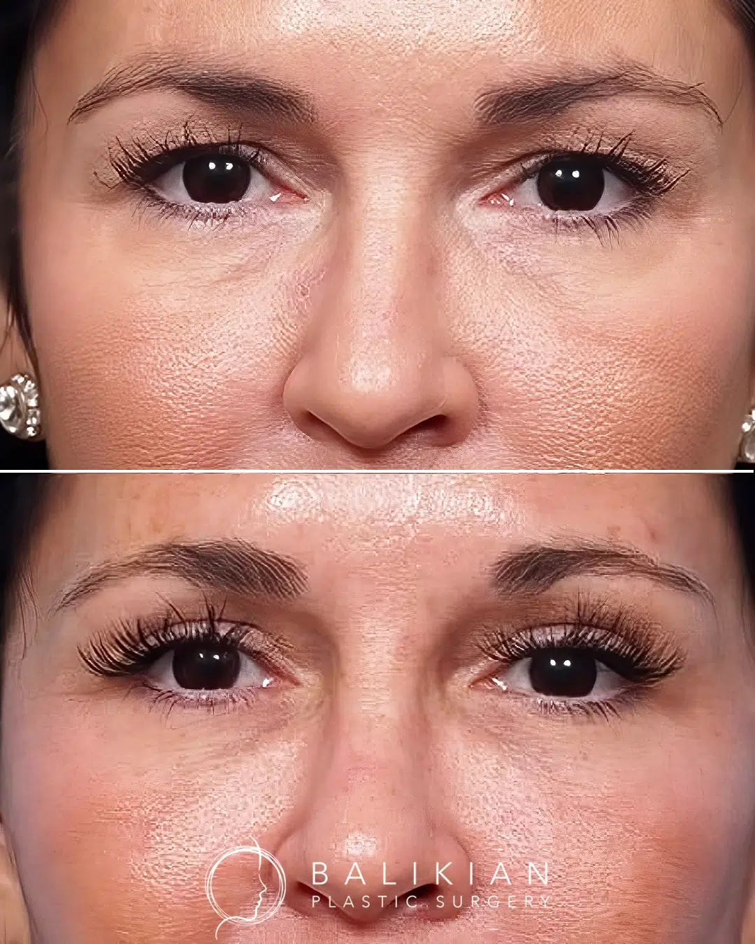 Before and after upper eyelid lift revealing reduced upper eyelid drooping and a brighter, more rejuvenated eye area.