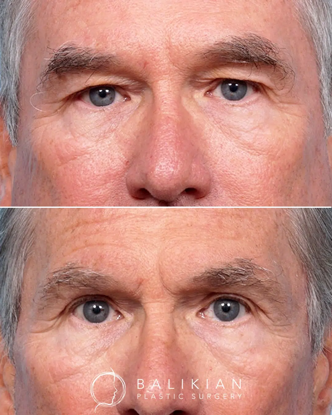 Before and after upper blepharoplasty on a male patient showing reduced heaviness of the upper eyelids and a more alert eye appearance.