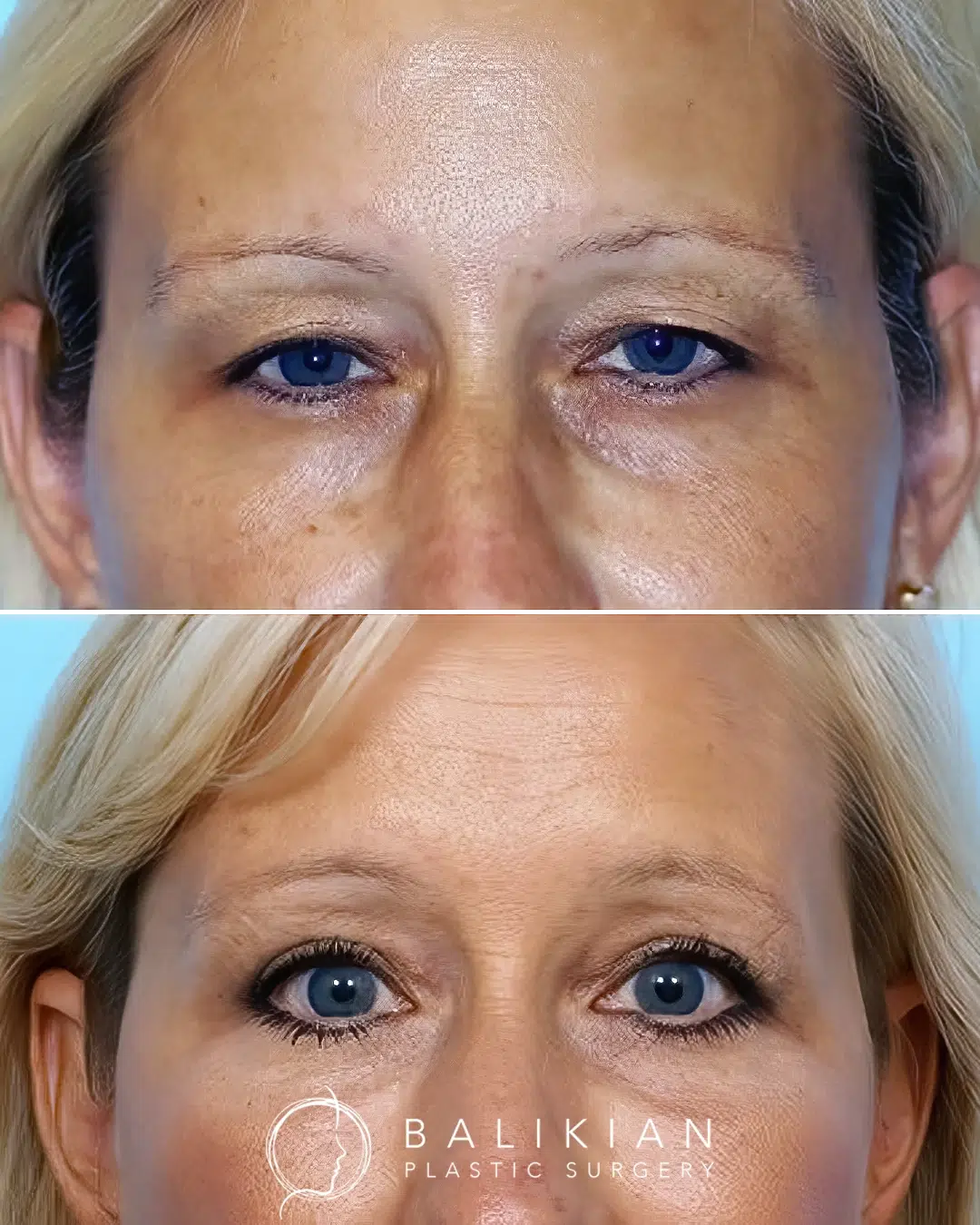 Before and after upper blepharoplasty showing smoother upper eyelids with reduced heaviness and a brighter, more awake eye appearance.