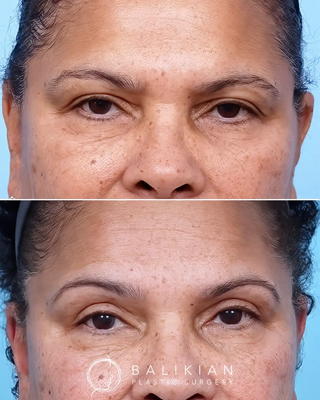 Before and after upper eyelid lift demonstrating removal of excess skin on the upper lids and a natural, refreshed look.