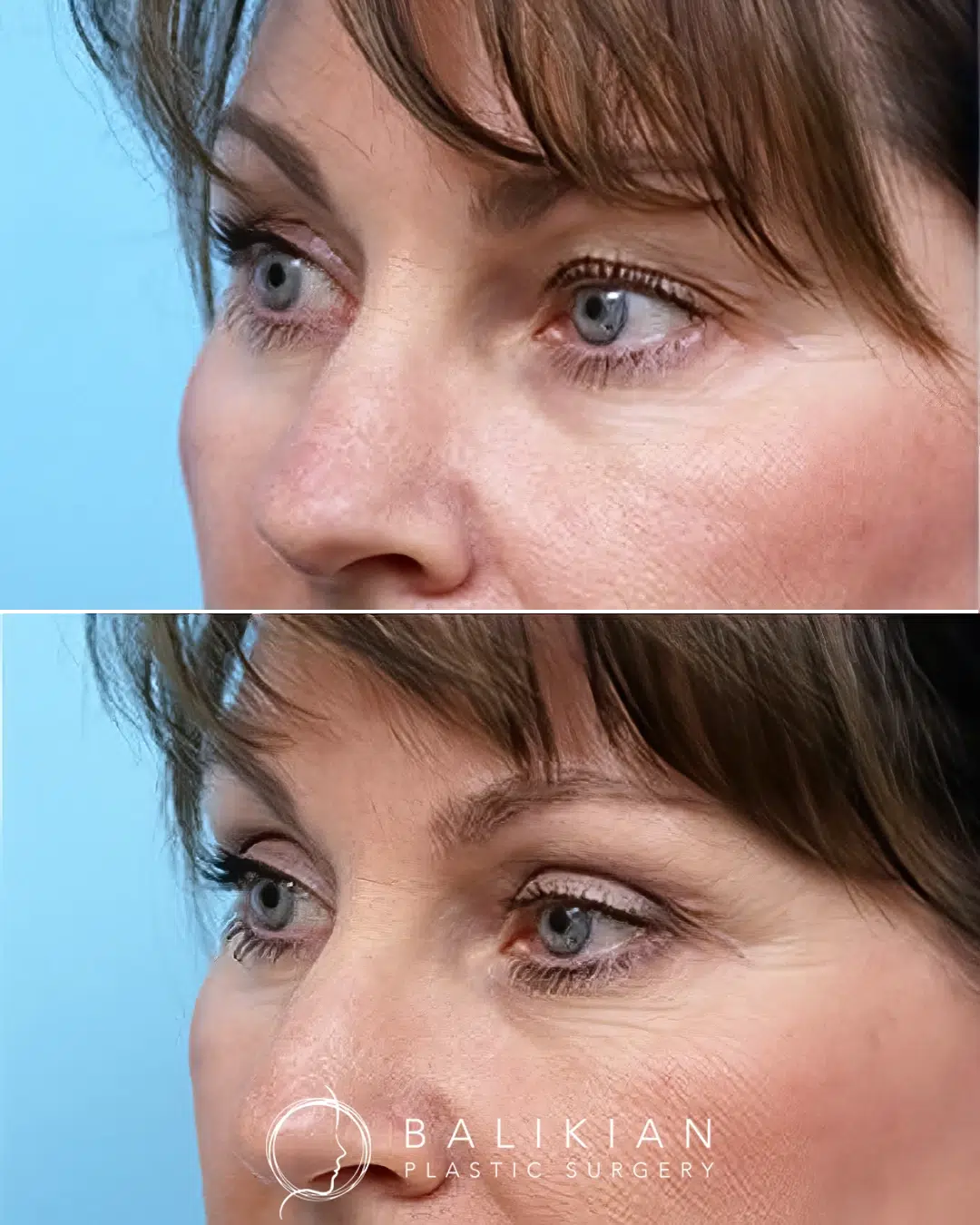 Before and after upper blepharoplasty showing improved upper eyelid contour with reduced hooding and a more youthful eyelid shape.