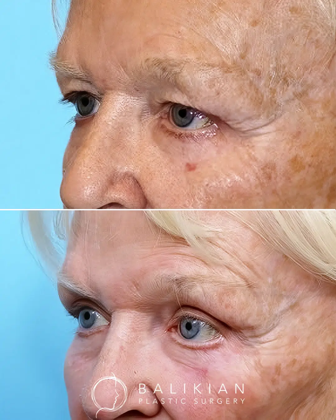 Before and after upper blepharoplasty highlighting smoother upper eyelids and a more open, rested appearance.