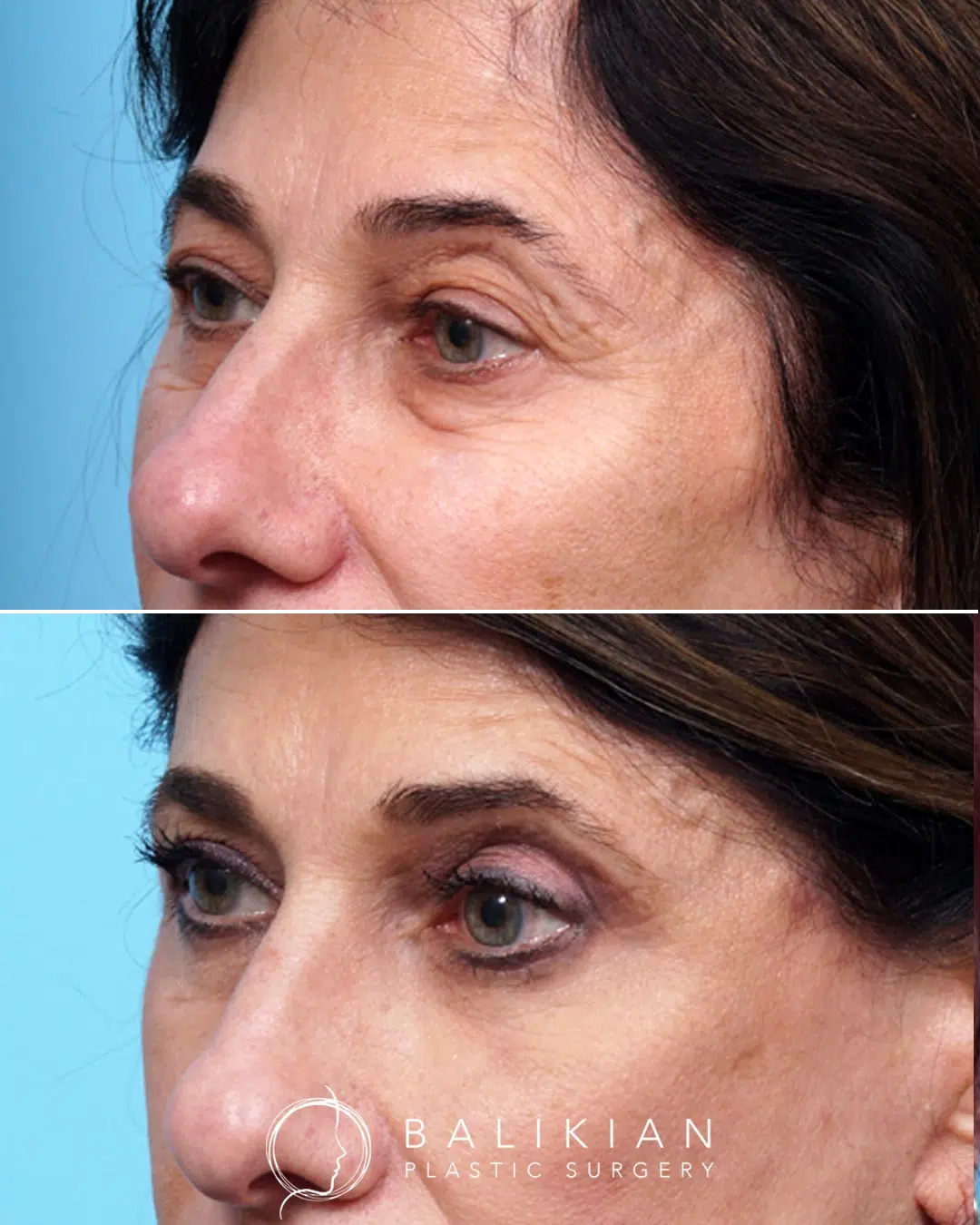 Before and after upper and lower blepharoplasty demonstrating correction of excess skin and puffiness around the eyes while maintaining the patient’s natural eye shape.
