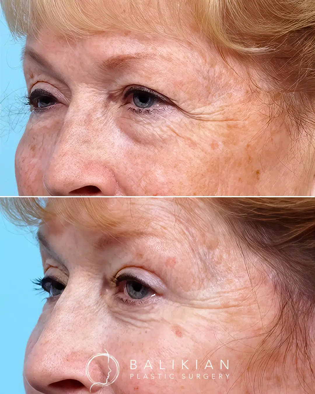Before and after upper and lower blepharoplasty showing reduced eyelid heaviness and softening of under eye fullness.