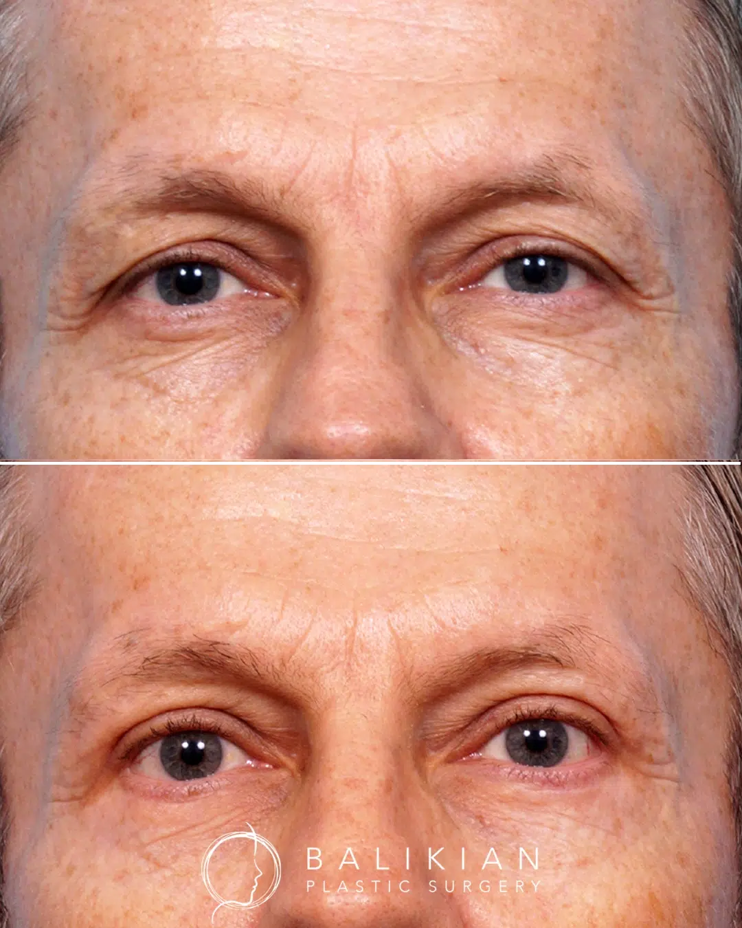 Before and after upper and lower blepharoplasty on a male patient showing improvement in eyelid heaviness and reduction of lower lid puffiness.