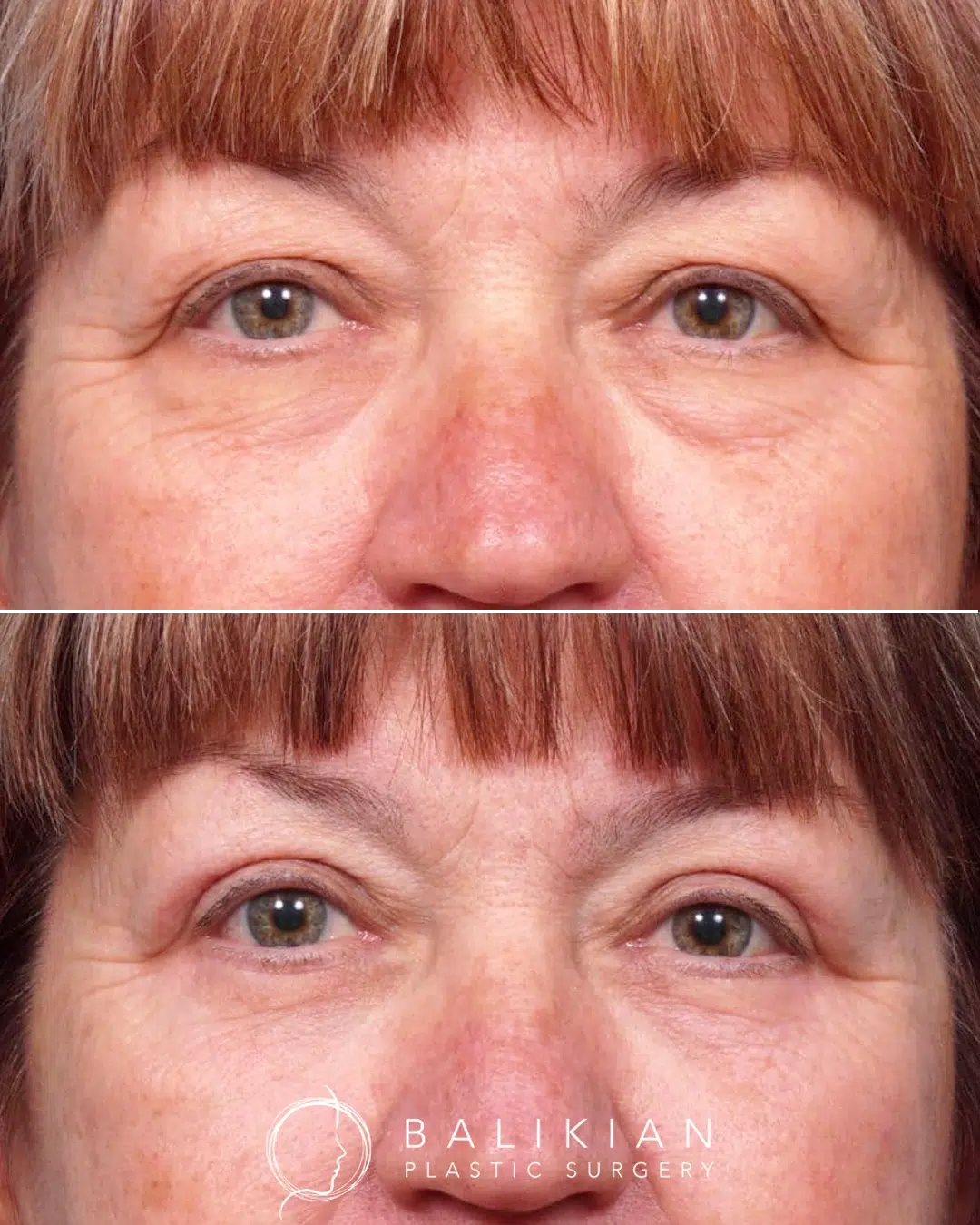 Before and after upper and lower eyelid lift showing smoother upper lids and diminished under eye bags for a refreshed appearance.