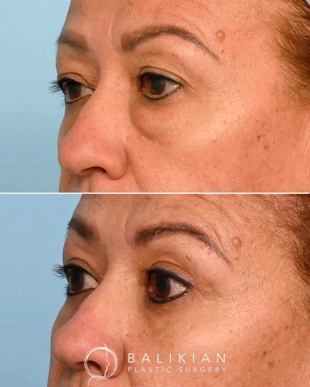 This patient wanted to address both upper and lower eyelids. Dr. Balikian recommended a temporal brow lift, upper blepharoplasty, and scarless lower blepharoplasty with fat transfer for balanced and natural-looking harmony. Before and after oblique-view upper and lower blepharoplasty showing lifted upper lids, reduced lower eyelid bulging, and a more rested overall eye appearance.