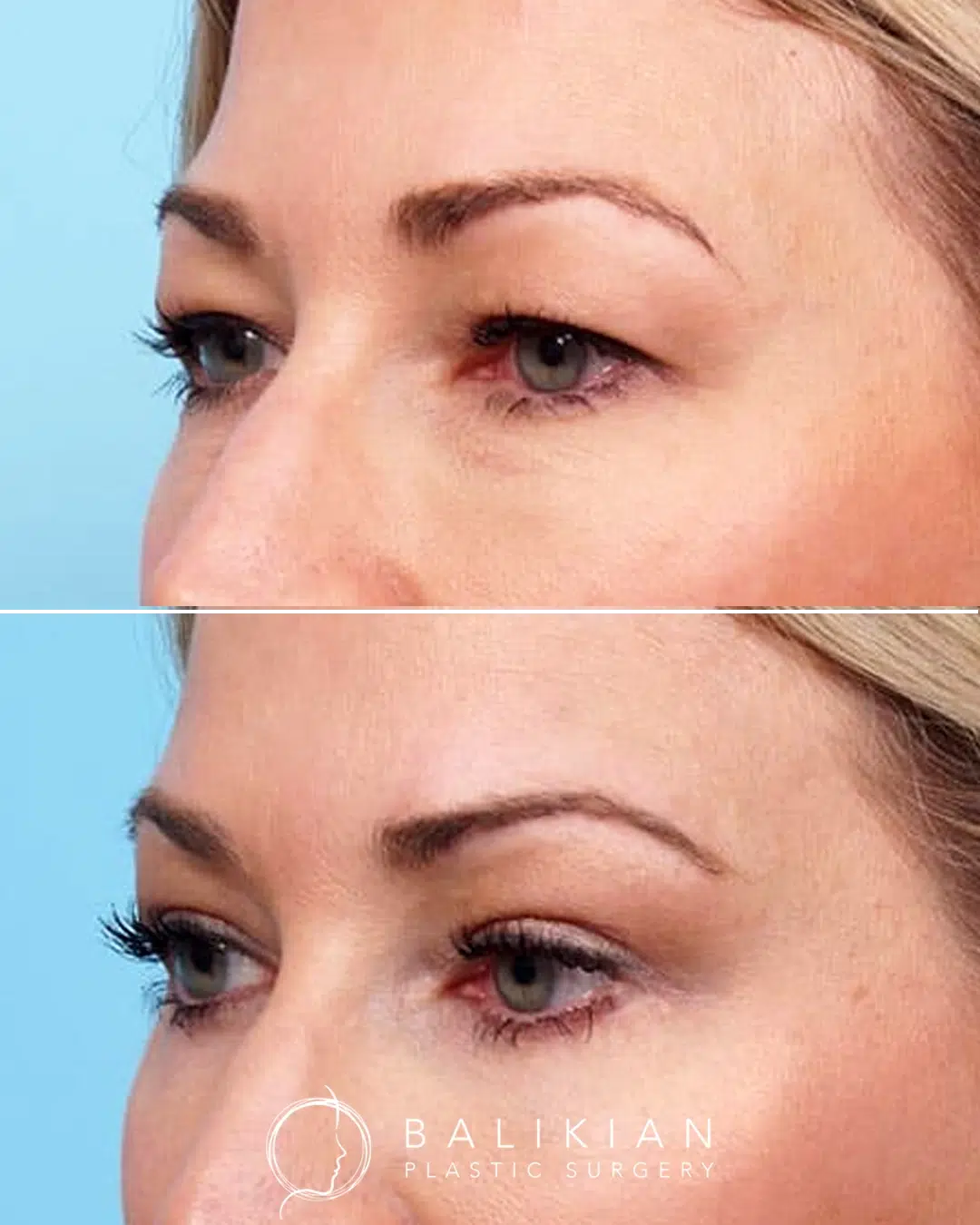 Before and after oblique view of upper and lower blepharoplasty showing reduced eyelid heaviness and softer under eye fullness.
