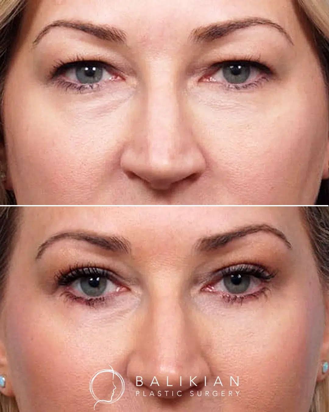 Before and after upper and lower blepharoplasty showing smoother upper lids, reduced puffiness beneath the eyes, and an overall brighter eyelid area.