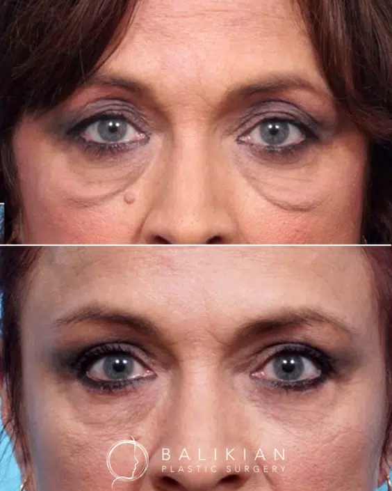 This patient had an upper and lower blepharoplasty combined with a facelift. Her results show rejuvenation of the eye area along with lifting of the jowl and improved neck definition. Before and after upper and lower eyelid surgery showing reduced under eye bags and smoother upper eyelids for a more rejuvenated look.