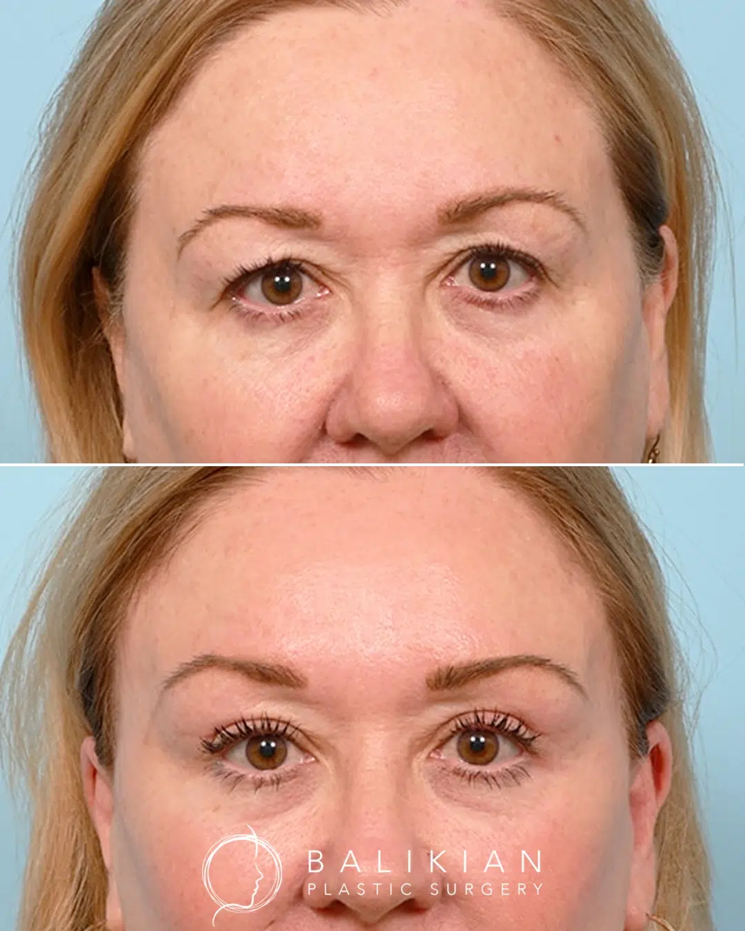 Before and after comprehensive eyelid rejuvenation showing reduced eyelid heaviness, smoother lower lids, and enhanced brightness around the eyes.