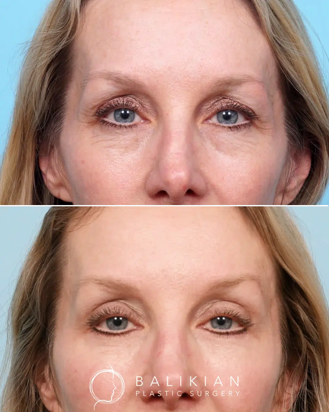 Before and after upper and lower eyelid surgery with fat transfer showing improved hollowness beneath the eyes, reduced puffiness, and a softer, more balanced under eye contour.