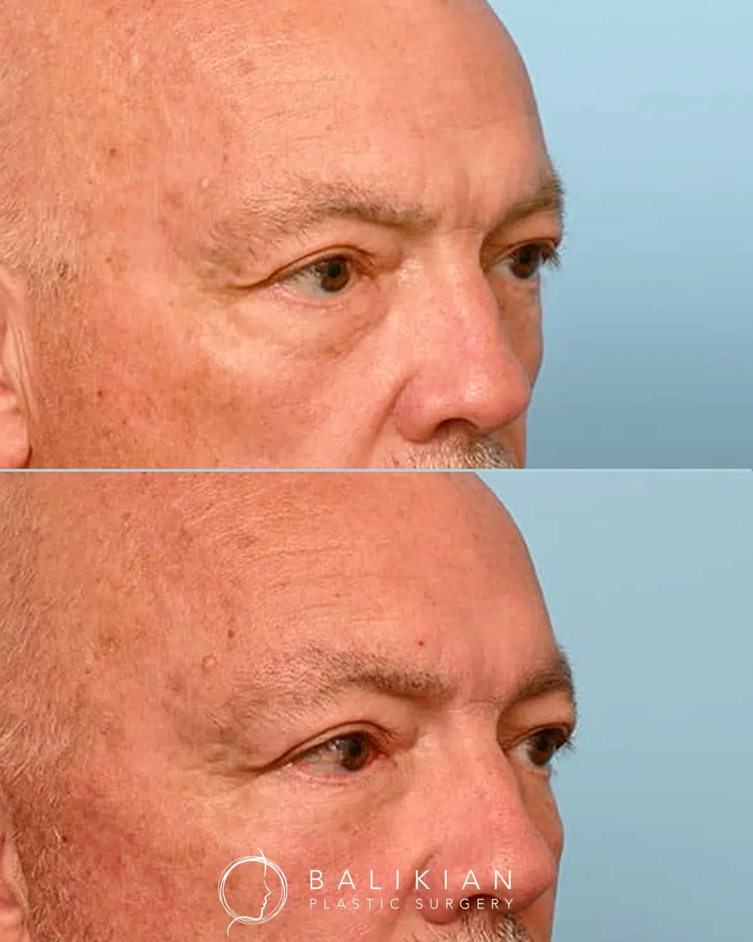 Before and after photos of a patient following extended deep plane facelift, deep neck lift, facial fat transfer, and lower blepharoplasty, demonstrating refreshed eyelids and improved facial definition while maintaining a natural look.