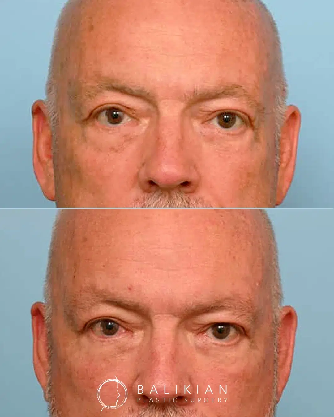 Before and after photos of a patient following extended deep plane facelift, deep neck lift, facial fat transfer, and lower blepharoplasty, demonstrating refreshed eyelids and improved facial definition while maintaining a natural look.