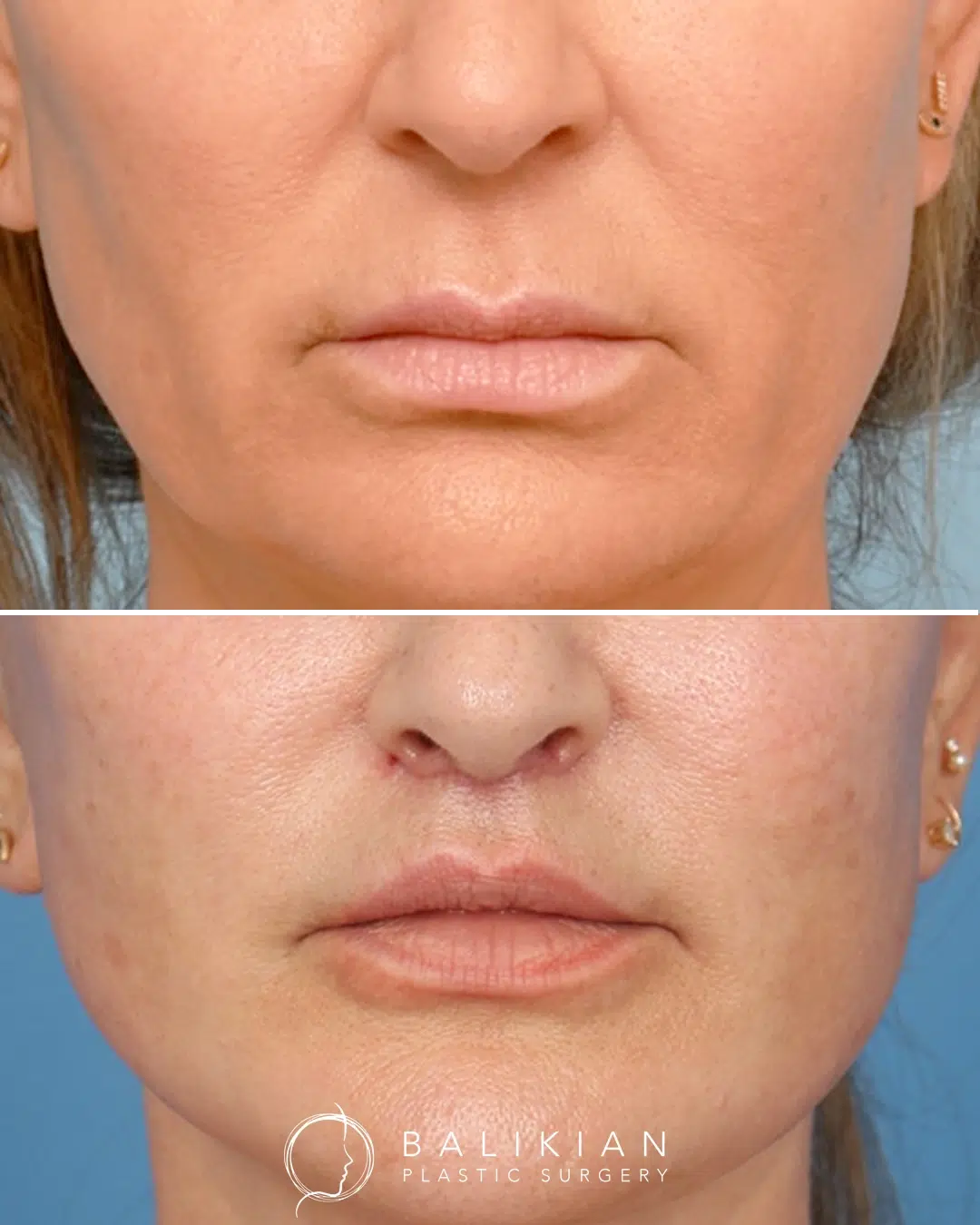 Shorten upper lip before and after showing a reduced philtrum length and improved upper lip shape following lip shortening.