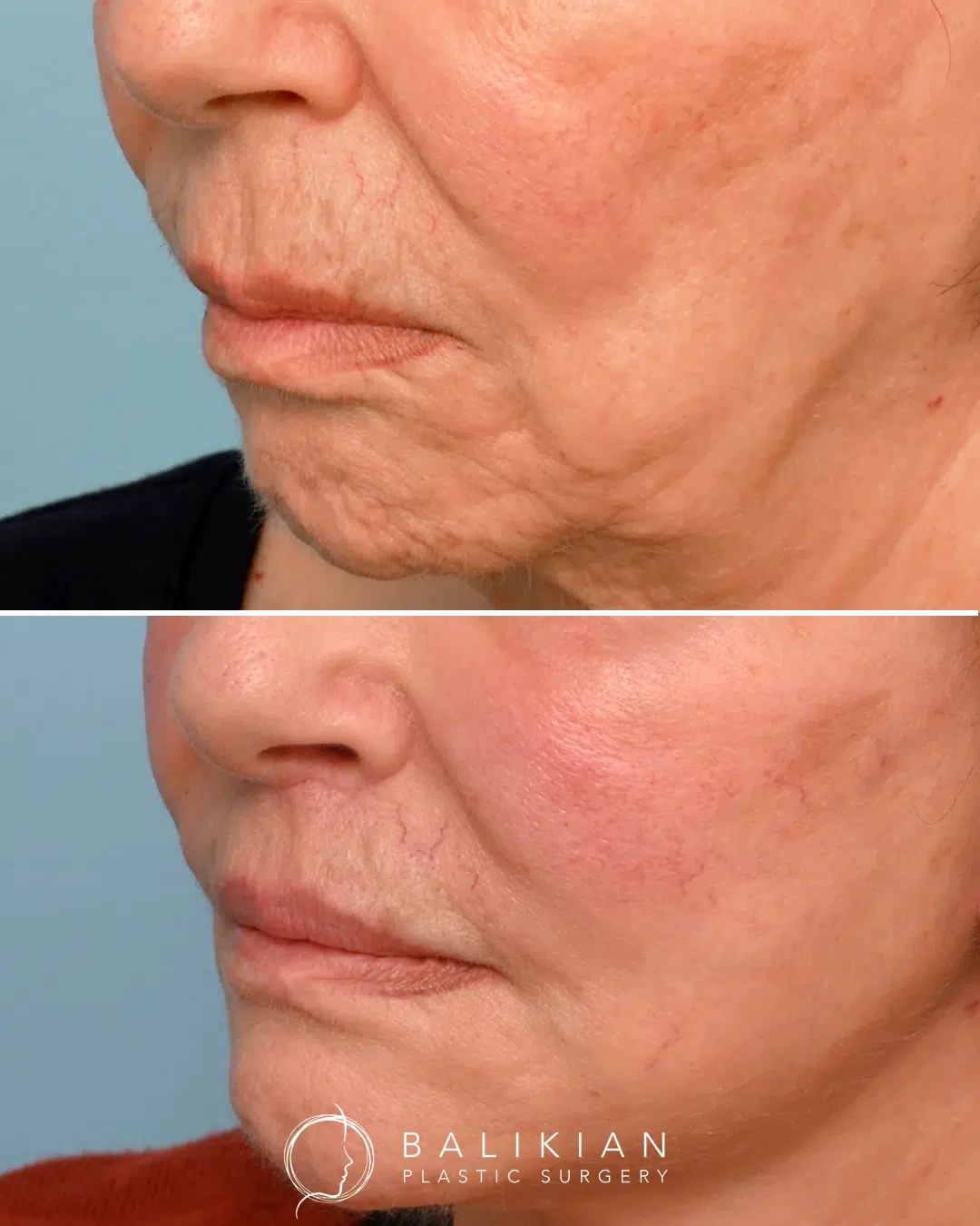 Subnasal lip lift before and after demonstrating shortened upper lip length and restored youthful proportions.