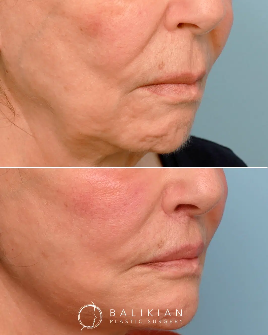 Philtrum shortening surgery before and after highlighting a lifted upper lip and increased pink lip show.