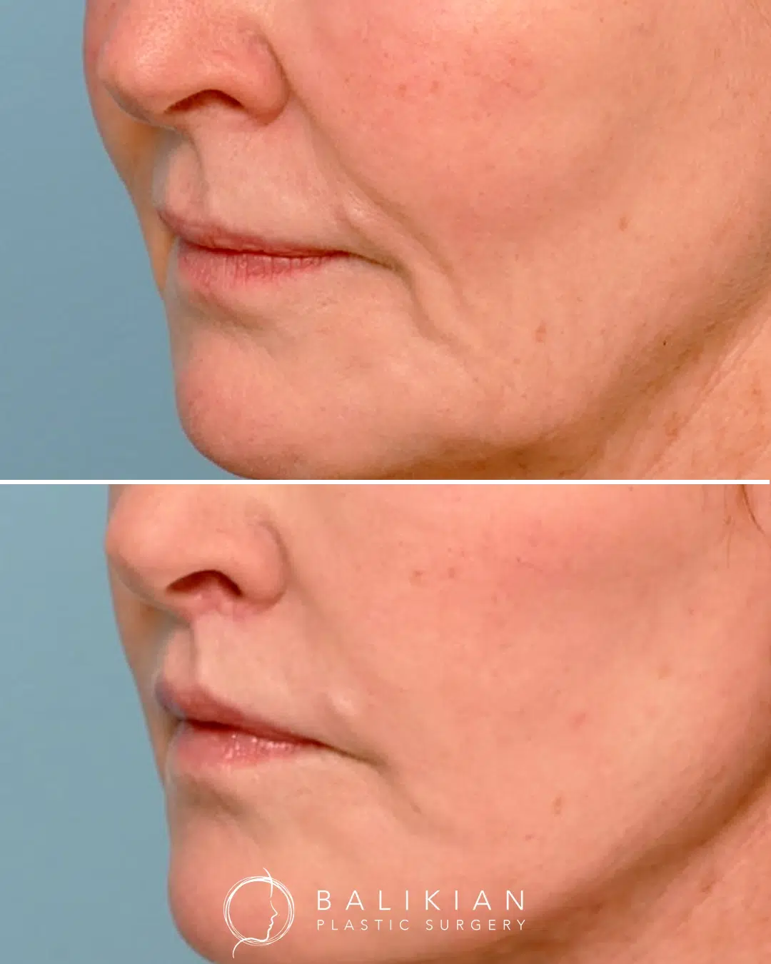 Before and after lip shortening with visible improvement in philtrum length and a naturally lifted upper lip.