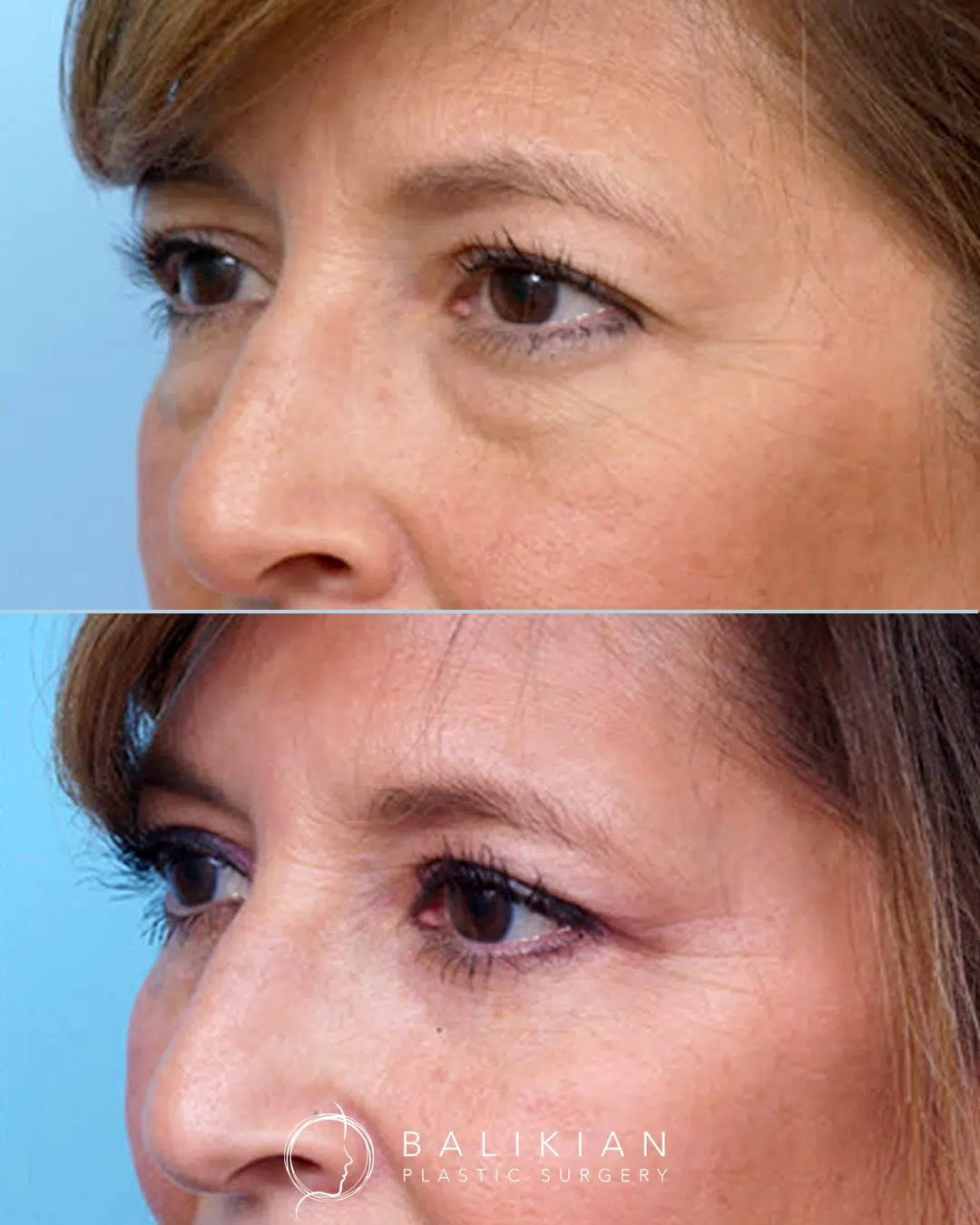Before and after images of an in-office lower blepharoplasty showing the removal of under-eye bags and smoother lower eyelids without changing the patient’s natural eye shape.