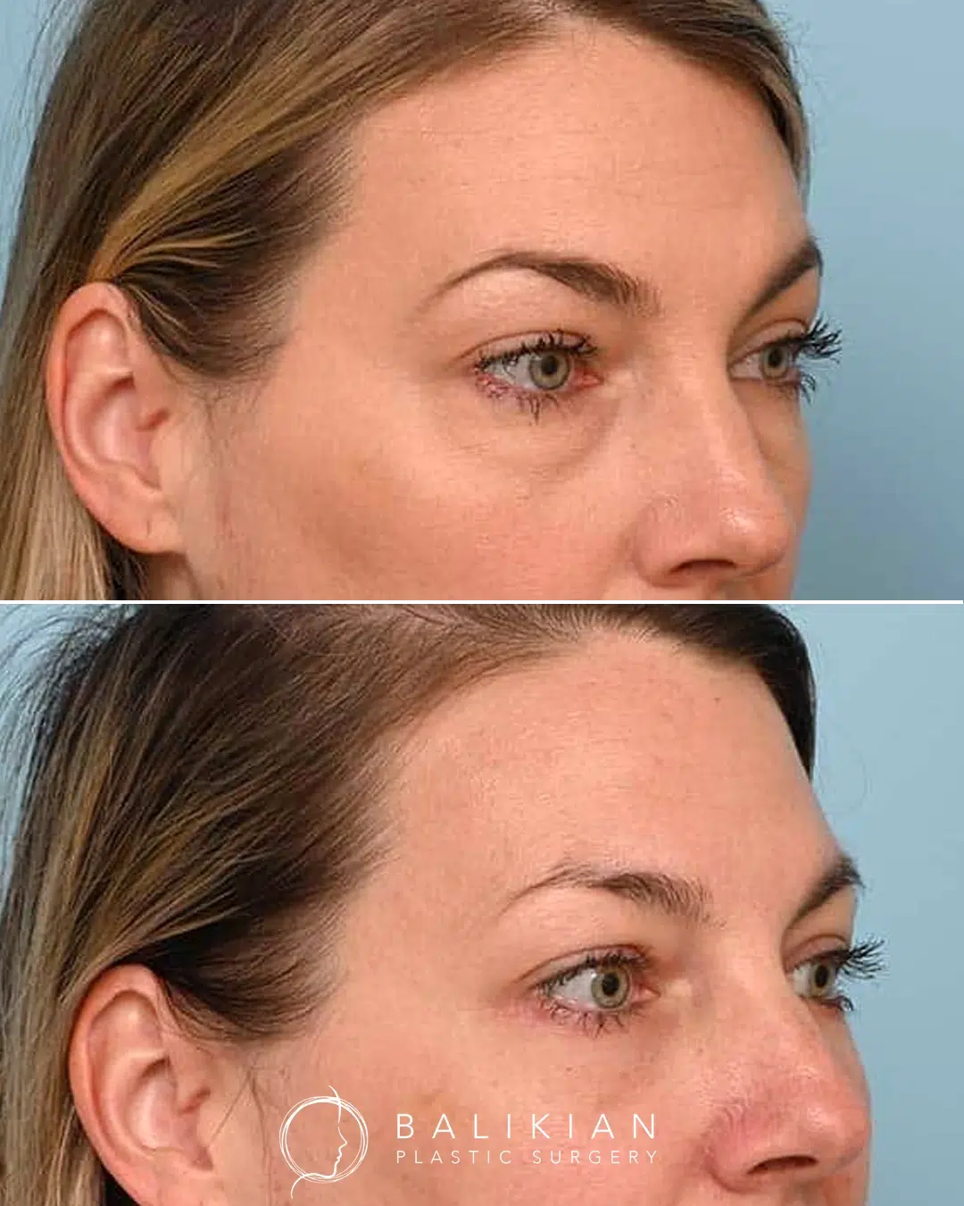 This patient in her 40s was bothered by her lower eyelids. Dr. Balikian performed a lower blepharoplasty with fat transfer to the lower lids and upper cheeks for a refreshed and natural result. Angled before and after view of lower blepharoplasty showing a natural reduction in under eye bags and improved skin smoothness for a refreshed look.