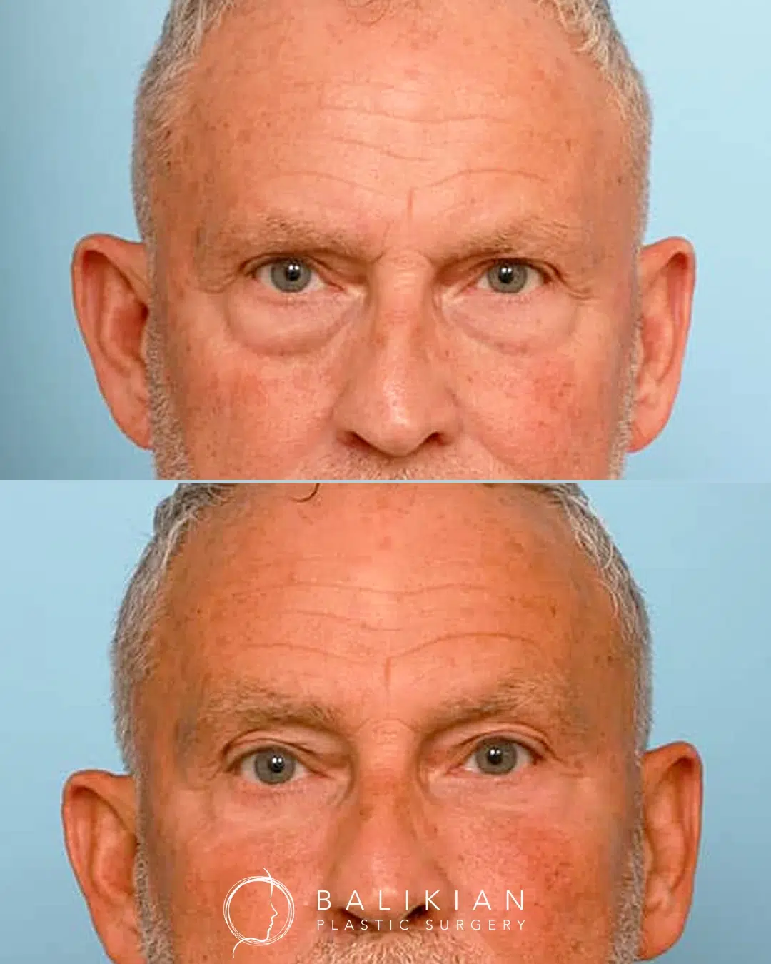 This patient in his 60s was bothered by fullness under the eyes. A scarless lower blepharoplasty with facial fat transfer smoothed the lower lids and improved the transition into the cheek area. Before and after image of a patient showing smoother under-eye contours and fuller cheeks after scarless lower blepharoplasty and facial fat transfer.