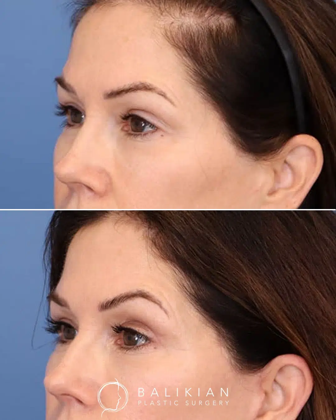 Before and after upper eyelid surgery showing removal of excess upper lid skin. The eyes appear more open and lifted with improved definition of the natural eyelid crease.