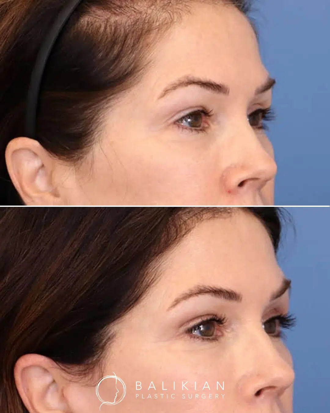 Angled before and after upper blepharoplasty showing a smoother upper lid contour and reduced heaviness. The eyes look brighter and more refreshed.