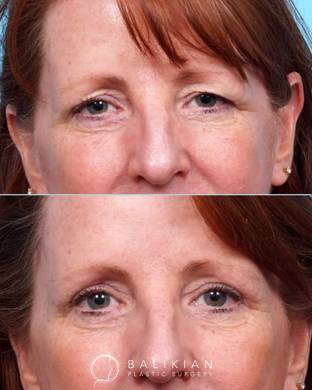 This patient from Apple Valley underwent an upper blepharoplasty and temporal lift to address a heavy brow. The combination opened her eyes and brightened her overall appearance. Before and after photo of a patient showing lifted upper eyelids and a brighter, more open appearance following upper blepharoplasty and temporal brow lift.